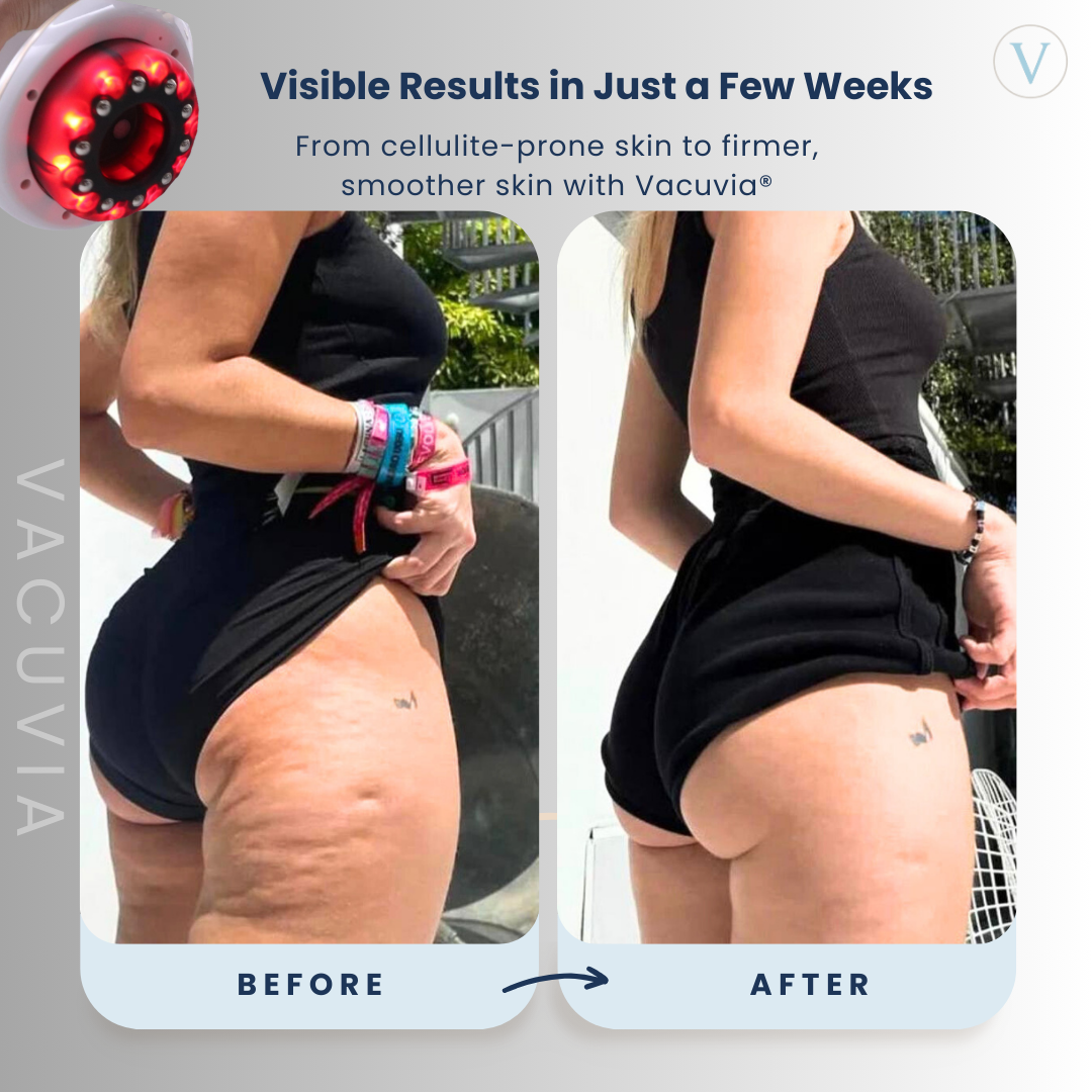 Vacuvia® SculptGlow™ – Firmer, More Toned Skin